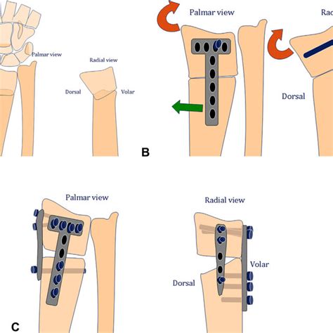 PDF Orthogonal Plate Fixation With Corrective Osteotomy For Treatment