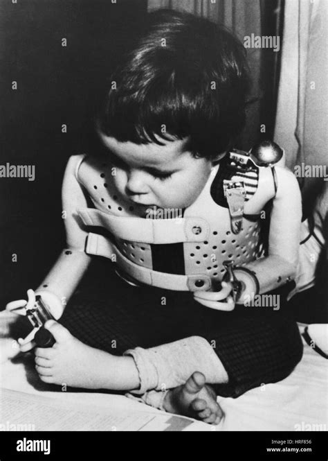 Thalidomide Baby Stock Photo - Alamy