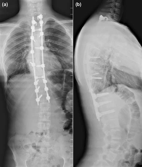 Post Operative Whole Spine Standing A Ap And B Lateral Views Download Scientific Diagram