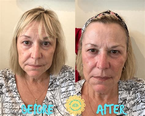 Infrared Thermal Facelift Anti Aging Treatment The Villages Fl