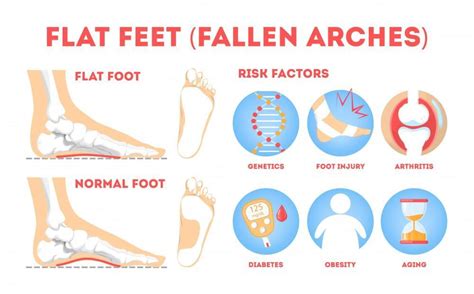 Adult Acquired Flatfoot Is It Serious Neuhaus Foot And Ankle Podiatry