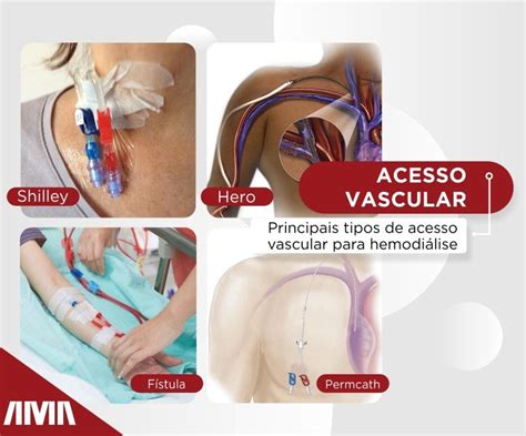 Conhe A Os Tipos De Acesso Vascular Para Hemodi Lise