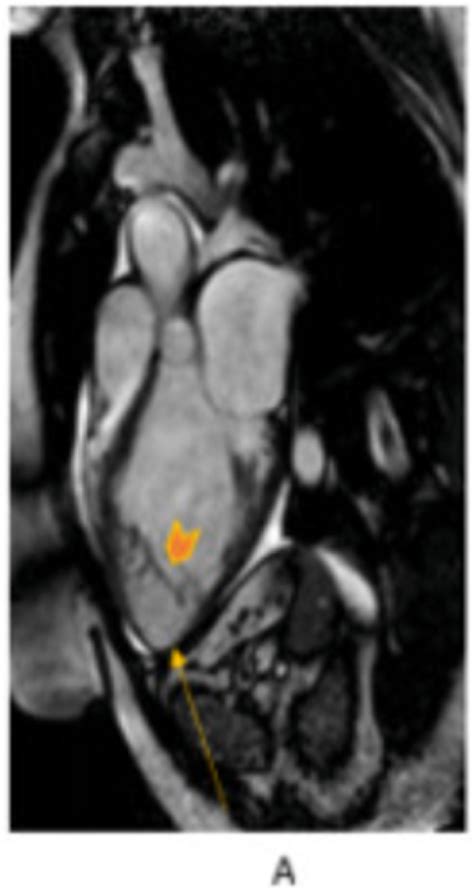 Three Chamber View Demonstrates Moderate Left Ventricular Dilation With Download Scientific