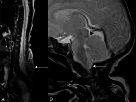 Chiari Malformations Concise Medical Knowledge