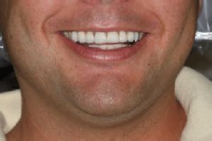 Smile Gallery Marcus Black Dds Best Dentist In Rogers Ar