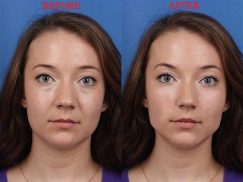 Best Face Plastic Surgery Cost In India Sculpt Clinic Face Plastic Surgery Plastic Surgery