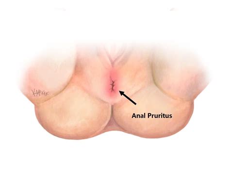 Anal Pruritus Endoscopy Online