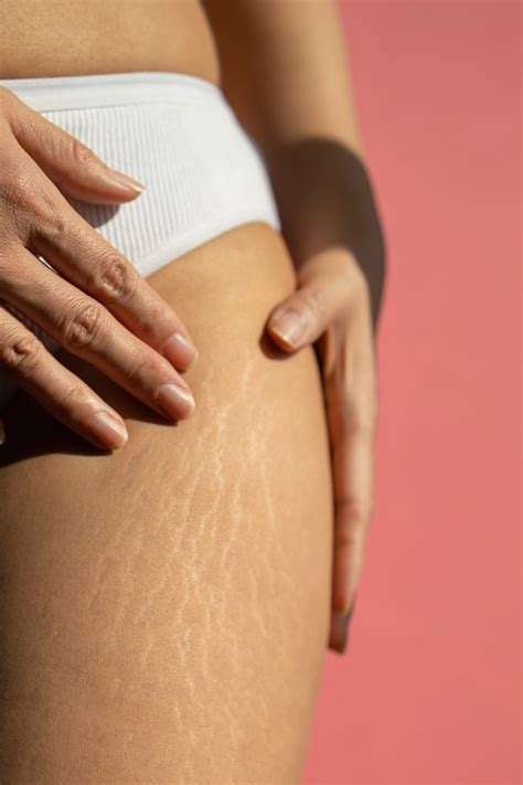 Stretch Marks