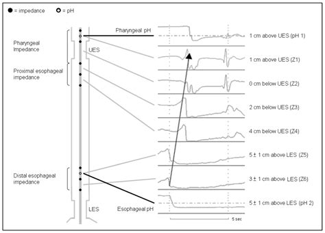 Diagnostics Free Full Text Diagnosis Of Laryngopharyngeal Reflux