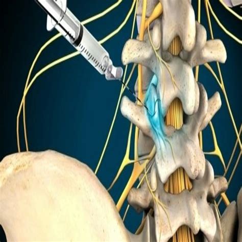 Medial Branch Blocks Facet Joint Injections Empire Spine And Pain