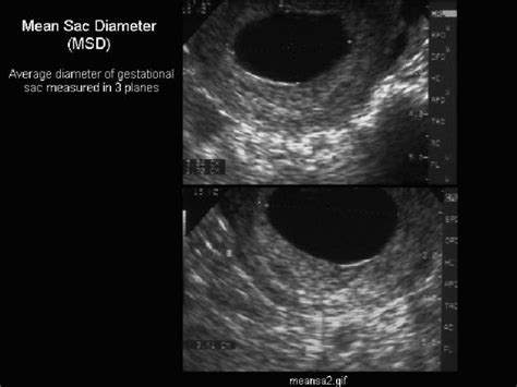 Gestational Sac And Yolk Size Chart - Best Picture Of Chart Anyimage.Org