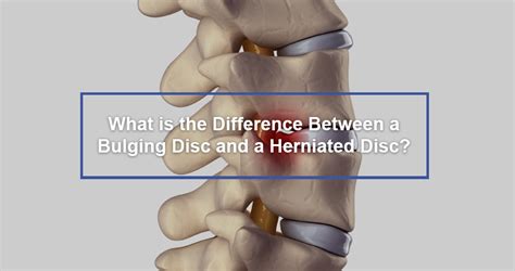 What Is The Difference Between A Bulging Disc And A Herniated Disc Dr Kevin Pauza The