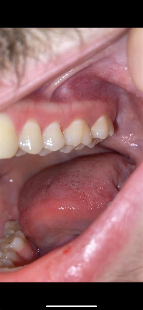 Skin sores and lesions 20M : r/askdentists