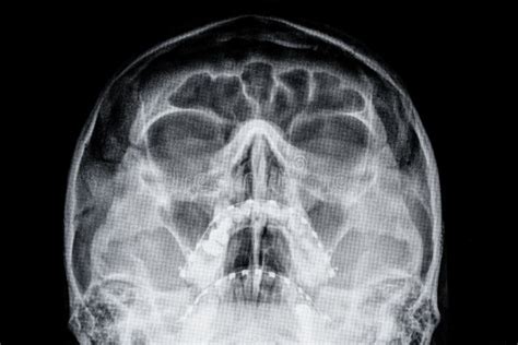 MRI Magnetic Resonance Image of the Human Brain and Head Stock Image ...