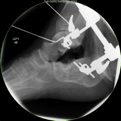 Distraction Arthrodesis Of Subtalar Joint Using A Laterally Placed