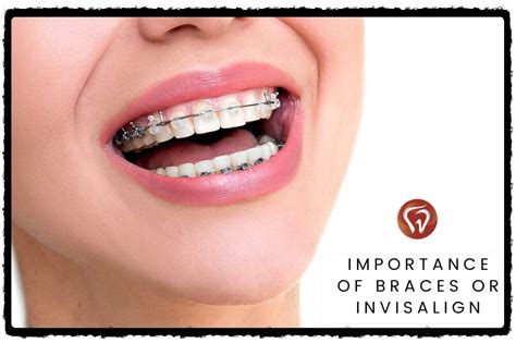 Can Braces Or Invisalign Fix Gaps Between Teeth Signature Smilez