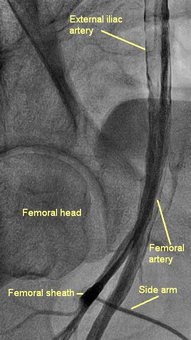 Femoral arterial sheath check shots – All About Cardiovascular System and Disorders