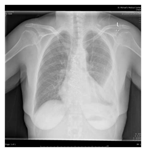 Posteroanterior Chest X Ray View Of A Patient Showing Opacification Of