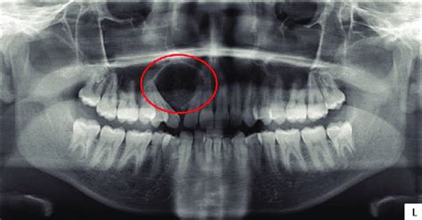 Orthopantomograph Showing A Well Defined Corticated Radiolucency With