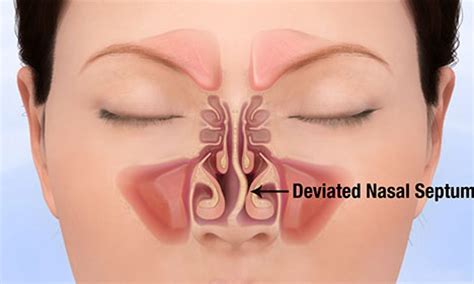 Deviated Nasal Septum: Understanding Causes, Symptoms, and Treatment ...