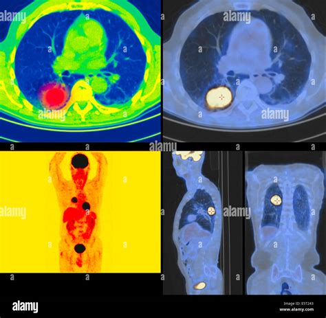 Positron Emission Tomography Scan