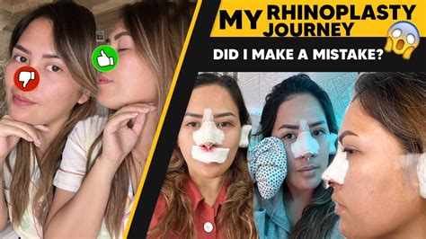 My Rhinoplasty Journey Everything You Need To Know Cost Post Op