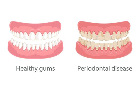 ĐIỀU TRỊ TỤT LỢI CHÂN RĂNG HIỆU QUẢ Nha khoa uy tín quận Gò Vấp TPHCM