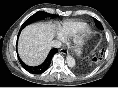 Axial Post Iv Contrast Ct Through The Lower Chest Upper Abdomen Showing Download Scientific