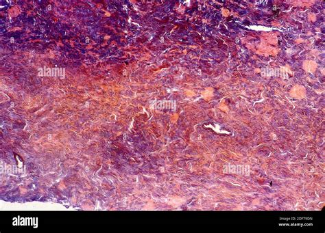 Fibrocartilage is a kind of cartilage tissue. Photomicrograph Stock ...