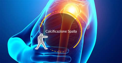 Calcificazione Spalla Come Si Forma E Come Si Cura Ryakos Center