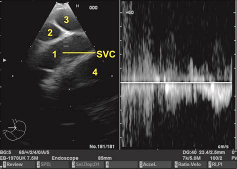 Techniques Of Linear Endobronchial Ultrasound Intechopen