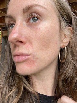 My Healing Journey With Perioral Dermatitis Artofit