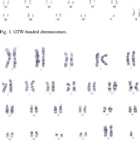 Williams Syndrome Chromosome