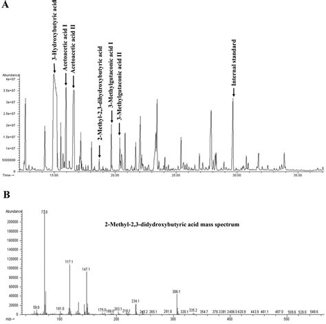 Gc Ms Of Organic Acids In Urine Of Echs1 Patient At 4 Months Of Life