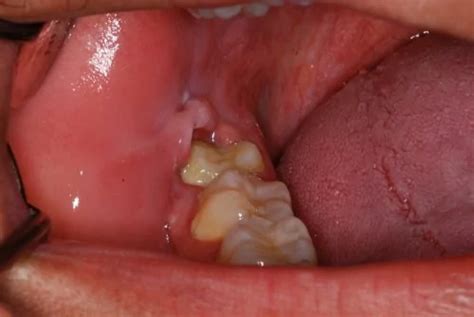 Inflamed Gums From Wisdom Teeth Wisdom Teeth Factory