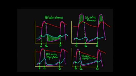 Wiggers Diagram Of All Valve Disorders Figure 4 Wiggers Dia