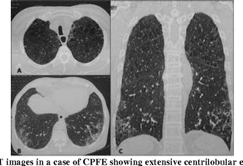 Pdf Combined Pulmonary Fibrosis And Emphysema Cpfe A Distinct