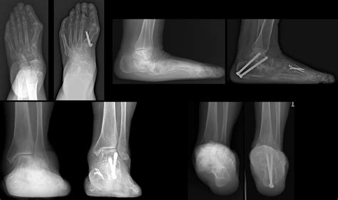 Isolated Subtalar Repositional Arthrodesis Compared With Triple