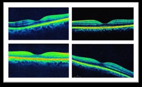 OCT Images of Human Eye. | Download Scientific Diagram