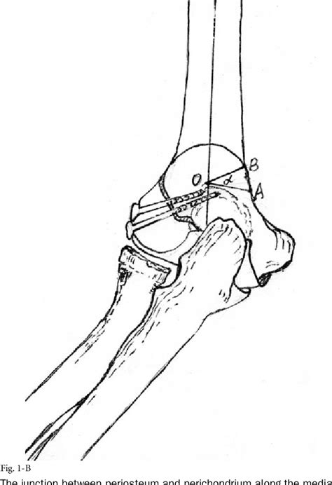 Supracondylar Dome Osteotomy For Cubitus Valgus Deformity Associated