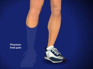 Understanding Phantom Limb Pain Pain Care Services in Salisbury and Rowan County Piedmont ...