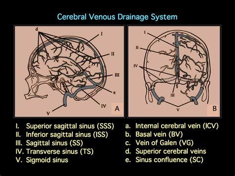 MRI BLOG: Dural Sinus Thrombosis