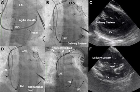 A Successful Ventricular Transseptal Puncture In Left Anterior Oblique