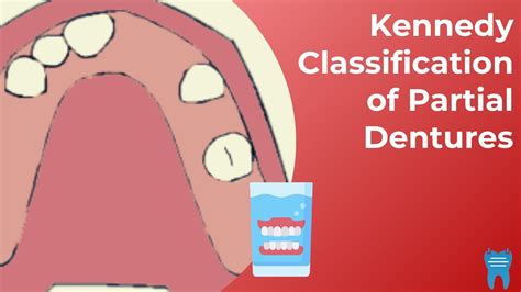 Kennedy Classification Of Removable Partial Dentures A Quick And Easy Classification Youtube