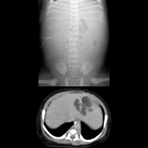 Pediatric Pyogenic Liver Abscess | Pediatric Radiology Reference ...