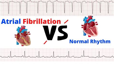 Atrial Fibrillation Vs Normal Heart Rhythm Comparison Made Easy