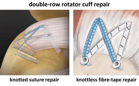 Rotator Cuff Disease Cambridge Shoulder