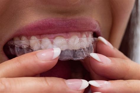 How Does Invisalign Straighten Your Smile