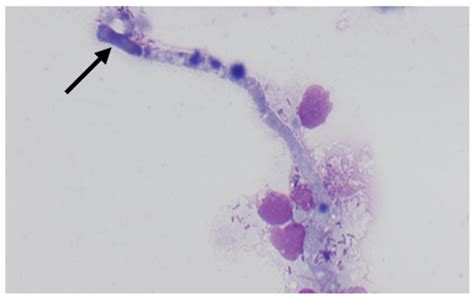 A Lethal Case Of Disseminated Cladosporium Allicinum Infection In A