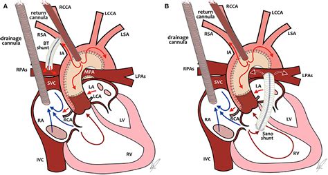 Frontiers Neonatal Cardiac Ecmo In 2019 And Beyond